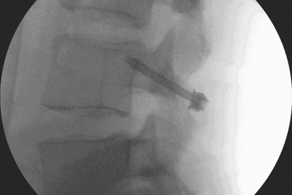 Surgeon Lester Wilson used real time x-rays to line up the titanium screw in Topley's L4 vertebrae.